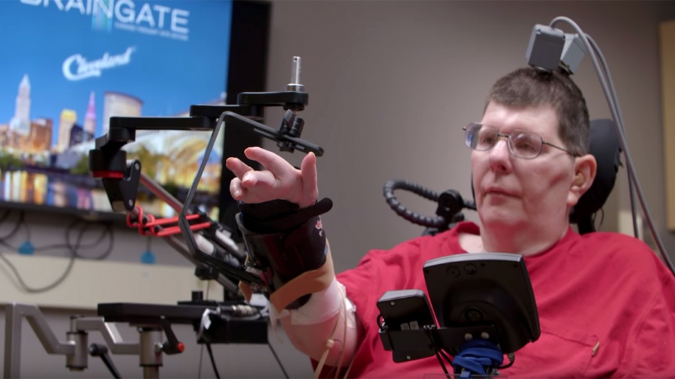 With BrainGatedirected muscle stimulation, a man with paralysis moves